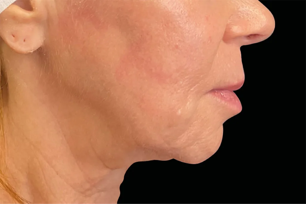 EMface facial toning Dublin - after photo of the neck in profile Neck in profile after EMface facial toning at our Dublin clinic